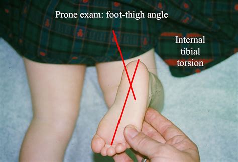 internal tibial torsion test|how to assess tibial torsion.